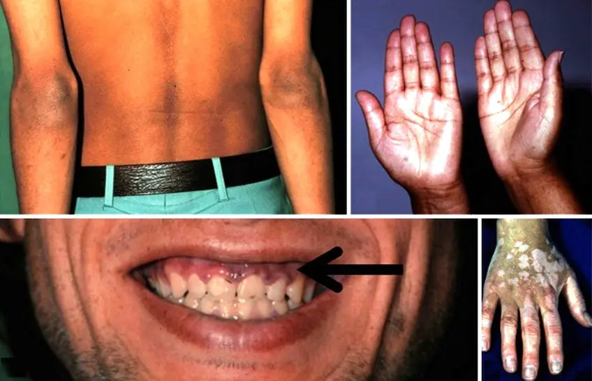 MEDICINA ONLINE Morbo di Addison IMMAGINE