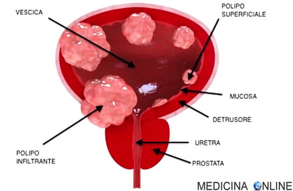 MEDICINA ONLINE POLIPI PAPILLOMA VESCICALE TUMORE CANCRO VESCICA URINA RENE RENI MORTE PROGNOSI RISTAGNO CALCOLO NEONATO GRAVIDANZA CONGENITO STADI DIETA GLOBO SINTOMI URETRA URETERE BACINETTO PELVI CALICI.jpg