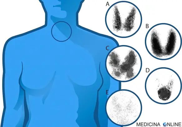 MEDICINA ONLINE SCINTIGRAFIA TIROIDEA COSTO RISULTATI NODULI CALDI FREDDI DIFFERENZA Thyroid scintigraphy