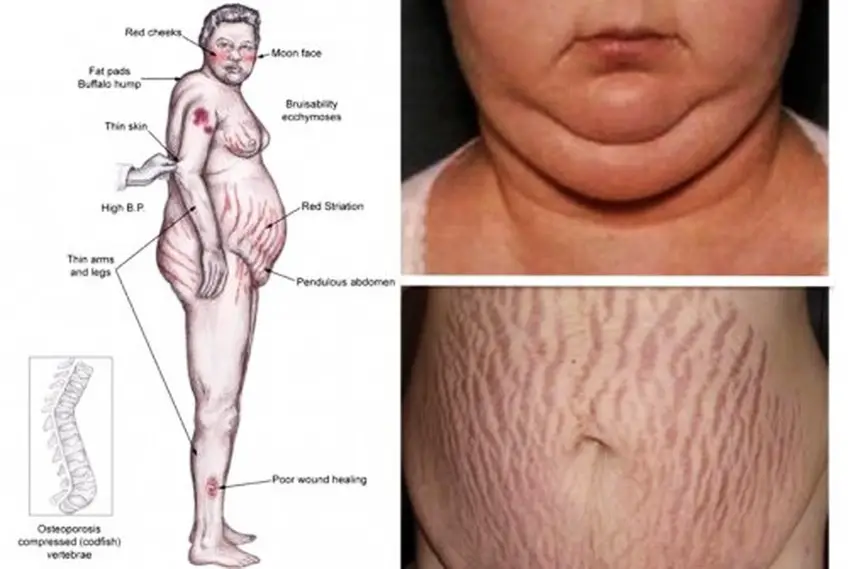 MEDICINA ONLINE SINDROME DI CUSHING Cushing Syndrome IMMAGINE