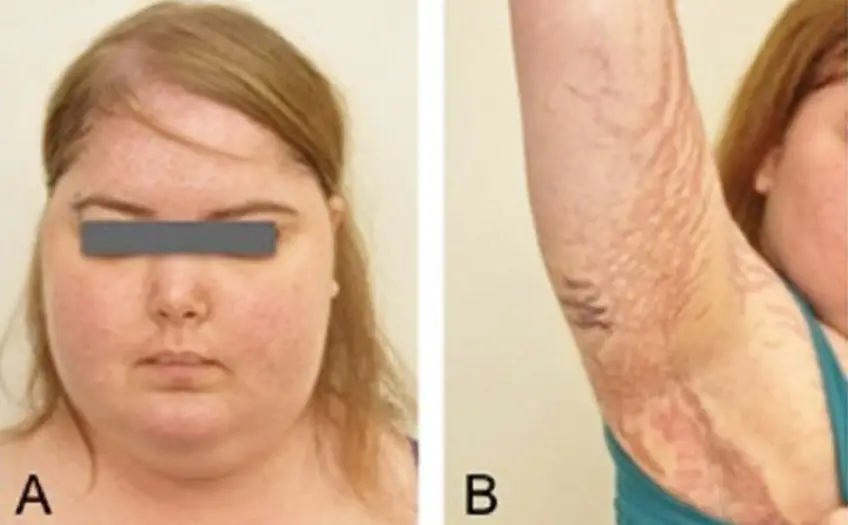 MEDICINA ONLINE SINDROME DI CUSHING Cushing Syndrome IMMAGINE