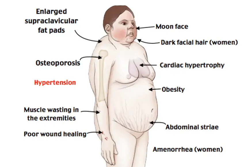 MEDICINA ONLINE SINDROME DI CUSHING Cushing Syndrome IMMAGINE
