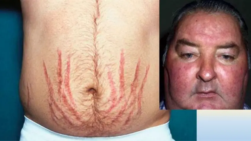 MEDICINA ONLINE SINDROME DI CUSHING Cushing Syndrome IMMAGINE