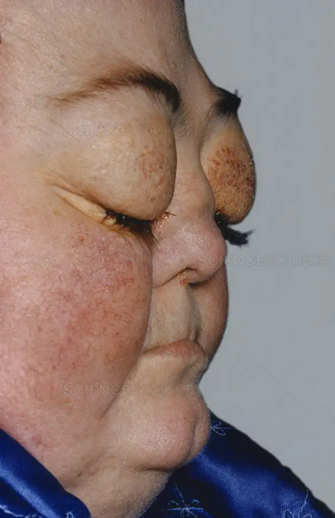 MEDICINA ONLINE SINDROME DI CUSHING Cushing Syndrome IMMAGINE