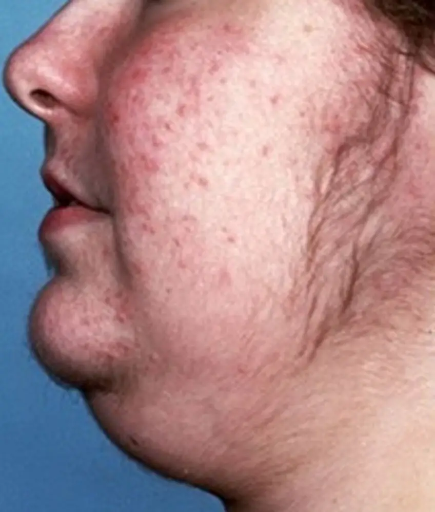 MEDICINA ONLINE SINDROME DI CUSHING Cushing Syndrome IMMAGINE