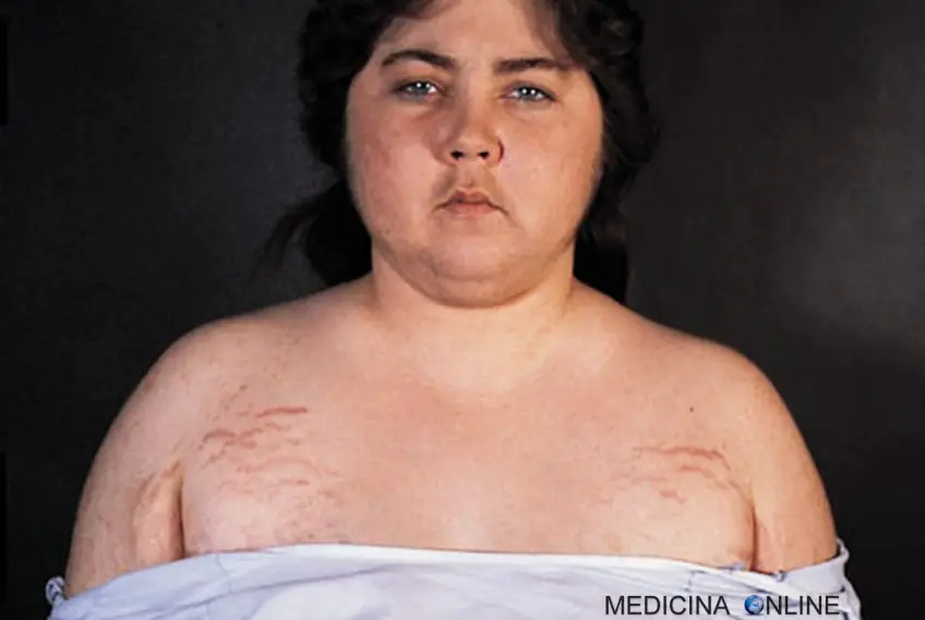MEDICINA ONLINE SINDROME DI CUSHING Cushing Syndrome IMMAGINE