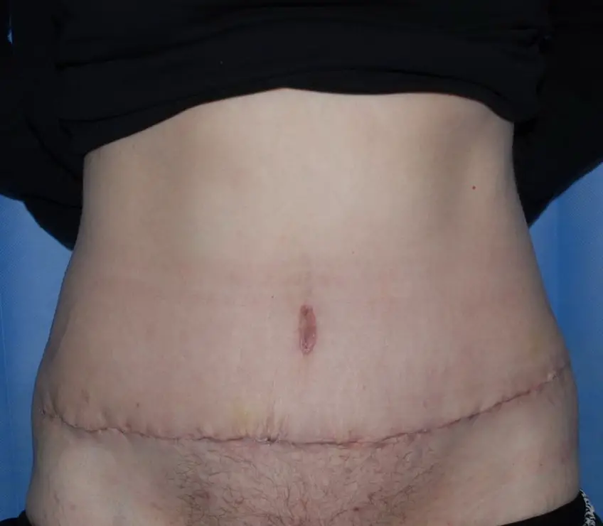 MEDICINA ONLINE ADDOMINOPLASTICA IMMAGINE