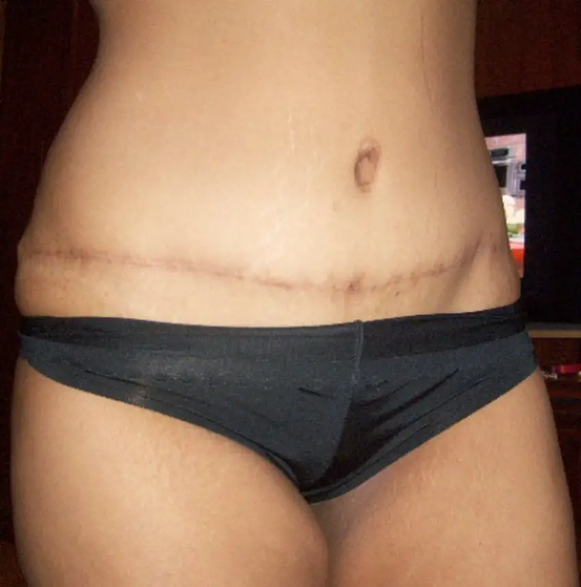 MEDICINA ONLINE ADDOMINOPLASTICA IMMAGINE