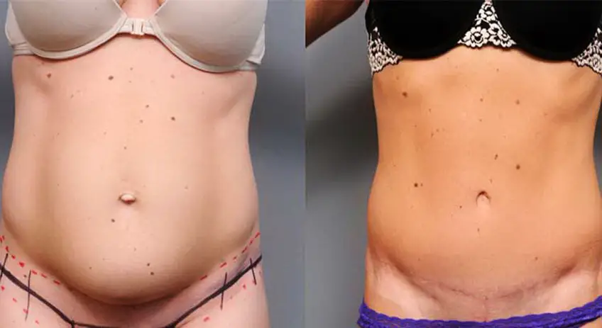 MEDICINA ONLINE ADDOMINOPLASTICA IMMAGINE