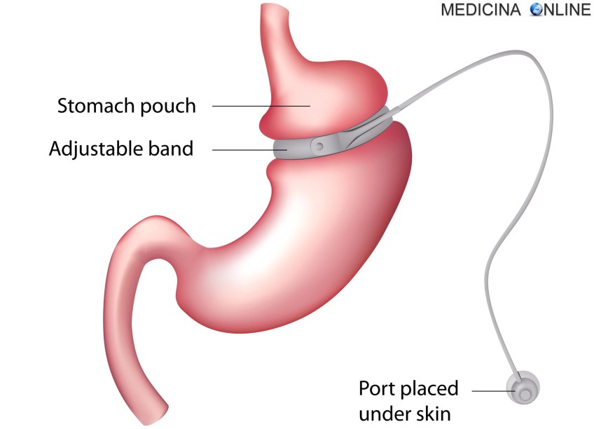 MEDICINA ONLINE BENDAGGIOGASTRICO STOMACO OBESITA PESO PERDITA DIMAGRIRE CHIRURGIA BARIATRICA DIABETE COSTO CONSEGUENZE