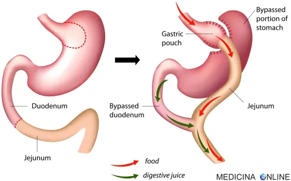 MEDICINA ONLINE BYPASS GASTRICO STOMACO BOBESITA PESO PERDITA DIMAGRIRE CHIRURGIA BARIATRICA DIABETE COSTO CONSEGUENZE Roux-en-Y.jpg