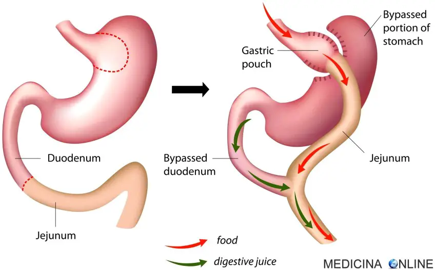 MEDICINA ONLINE BYPASS GASTRICO STOMACO OBESITA PESO PERDITA DIMAGRIRE CHIRURGIA BARIATRICA DIABETE COSTO CONSEGUENZE Roux-en-Y