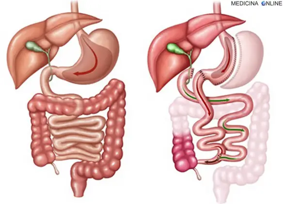 MEDICINA ONLINE DIVERSIONE BILIOPANCREATICA DUODENAL SWITCH CHIRURGIA BARIATRICA OBESITA