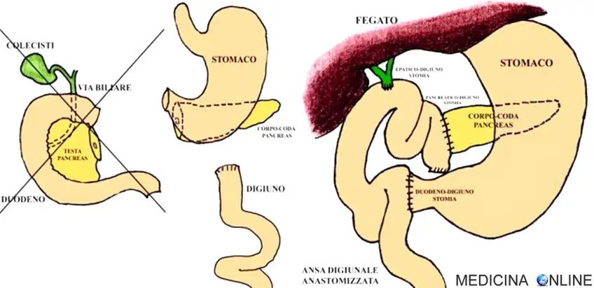 MEDICINA ONLINE Duodenocefalopancresectomia WHIPPLE complicanze dieta PANCREAS TESTA COLECISTI CISTIFELLEA STOMACO DUODENO INTESTINO CANCRO TUMORE MORTE SOPRAVVIVENZA ASPETTATIVA DI VITA