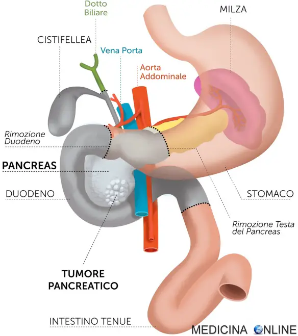 MEDICINA ONLINE Duodenocefalopancresectomia WHIPPLE complicanze dieta PANCREAS TESTA COLECISTI CISTIFELLEA STOMACO DUODENO INTESTINO CANCRO TUMORE MORTE SOPRAVVIVENZA ASPETTATIVA DI VITA.jpg