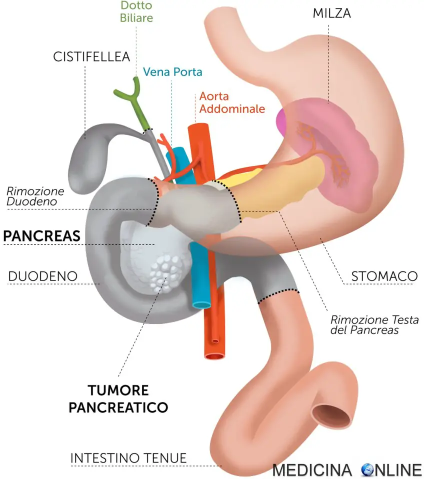 MEDICINA ONLINE Duodenocefalopancresectomia WHIPPLE complicanze dieta PANCREAS TESTA COLECISTI CISTIFELLEA STOMACO DUODENO INTESTINO CANCRO TUMORE MORTE SOPRAVVIVENZA ASPETTATIVA DI VITA