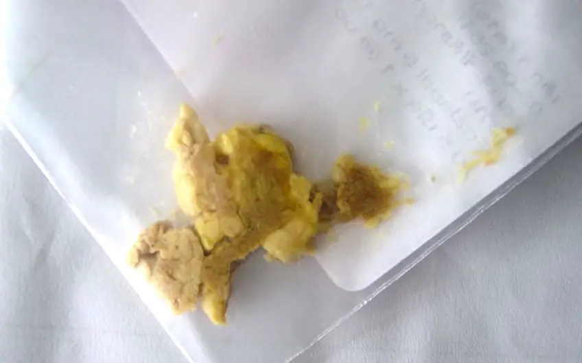 MEDICINA ONLINE FECI STEATORREA