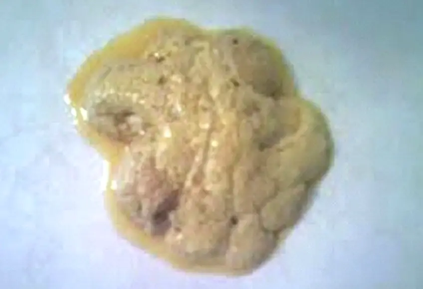 MEDICINA ONLINE FECI STEATORREA