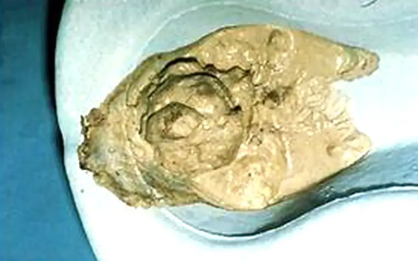 MEDICINA ONLINE FECI STEATORREA