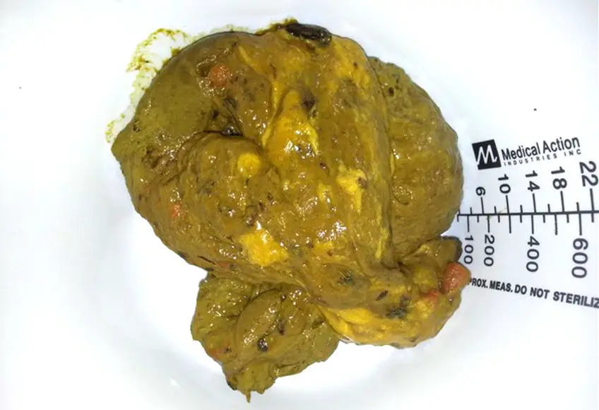 MEDICINA ONLINE FECI STEATORREA