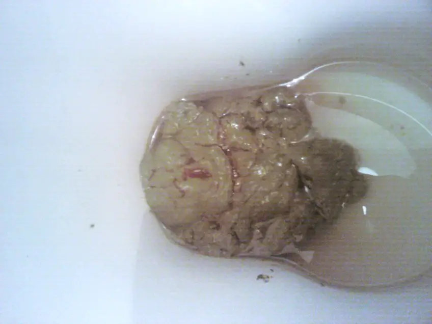 MEDICINA ONLINE FECI STEATORREA