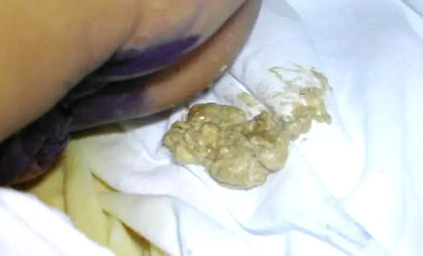 MEDICINA ONLINE FECI STEATORREA