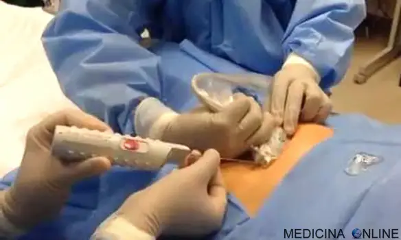 MEDICINA ONLINE FEGATO ECOGUIDATA BIOPSIA PERCUTANEA  ECOGRAFIA AGO DOLORE FA MALE ASPIRATO CHIRURGIA CHIRURGO EPATICA.jpg