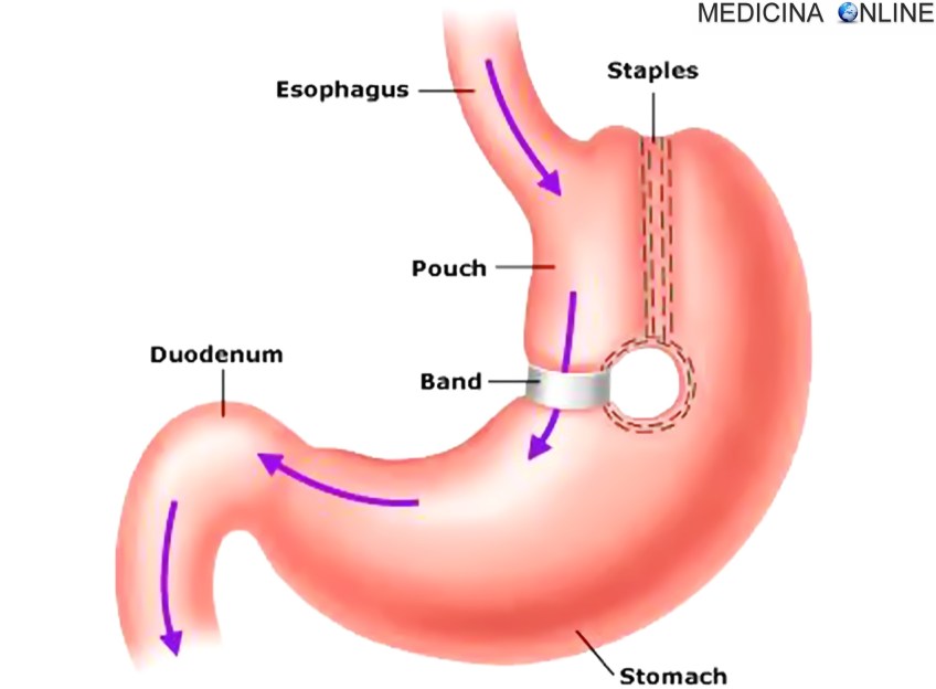 MEDICINA ONLINE GASTROPLASTICA VERTICALE STOMACO OBESITA PESO PERDITA DIMAGRIRE CHIRURGIA BARIATRICA DIABETE COSTO CONSEGUENZE