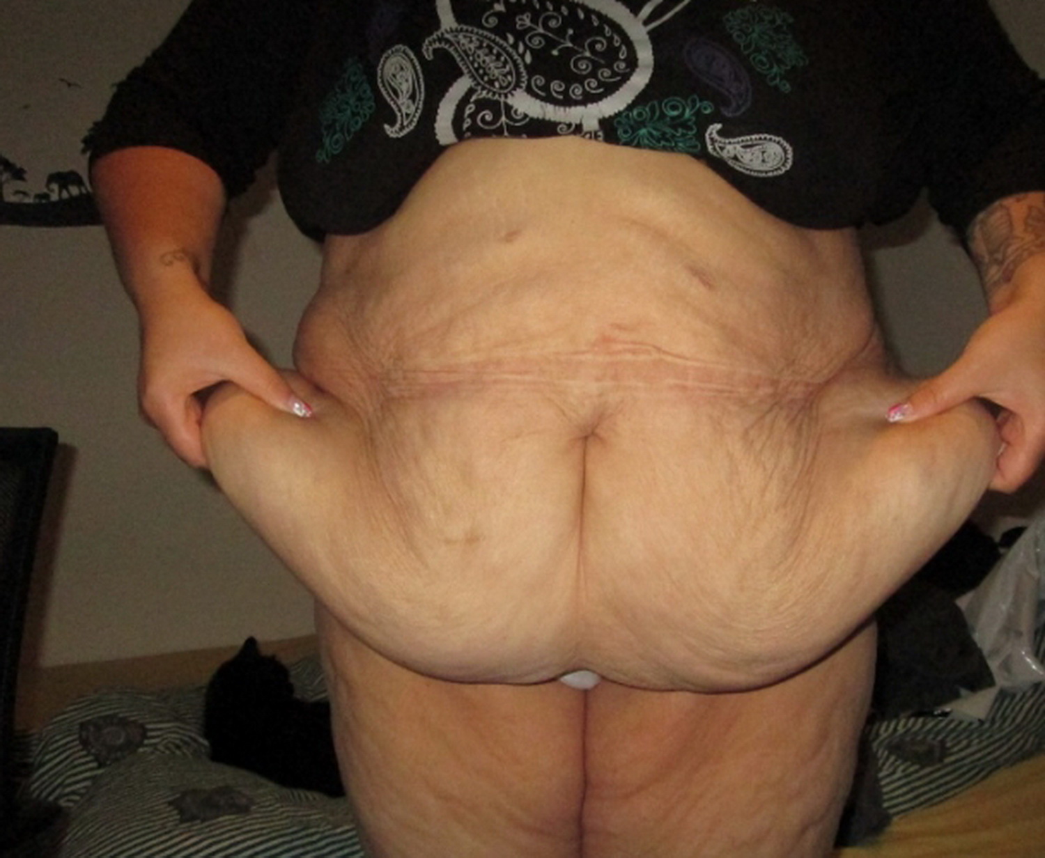 MEDICINA ONLINE GREMBIULO ADIPOSO ADDOMINOPLASTICA IMMAGINE