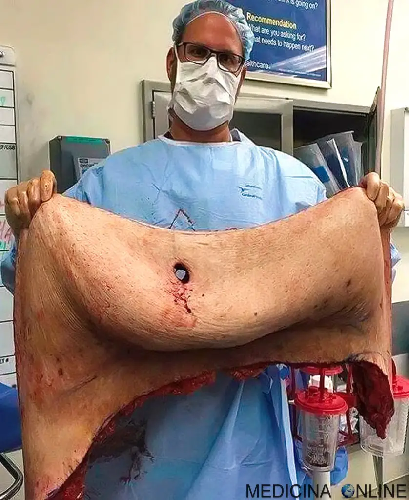 MEDICINA ONLINE GREMBIULO ADIPOSO ADDOMINOPLASTICA IMMAGINE