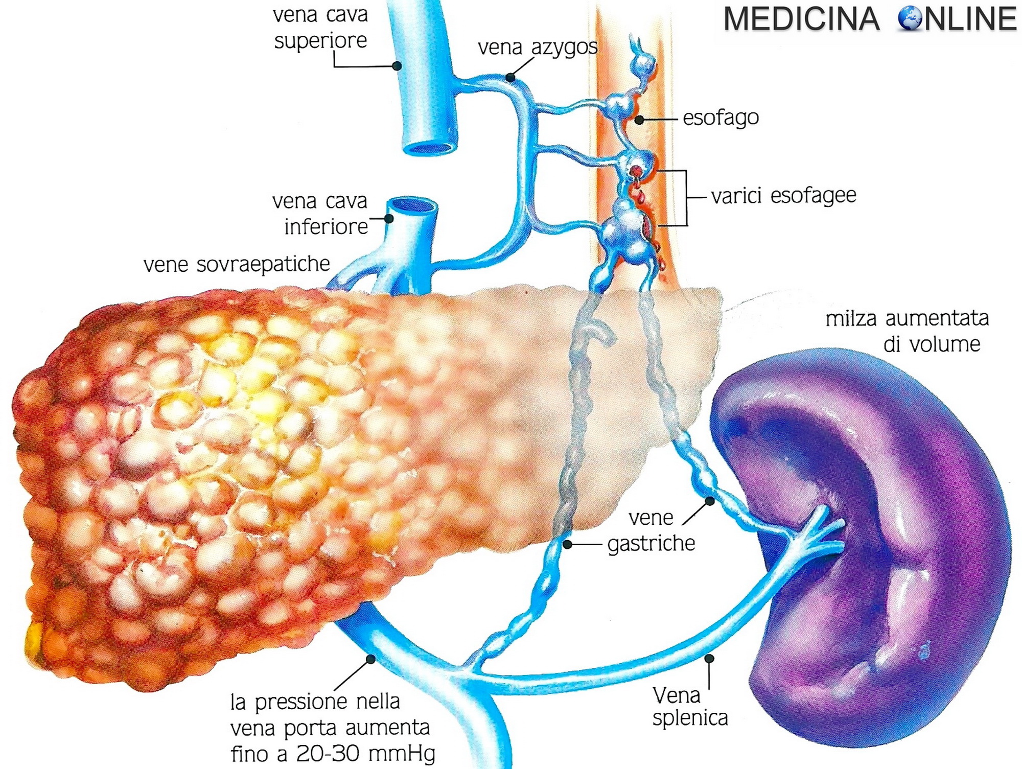 Varici esofagee: classificazione, dieta, legatura, complicanze | MEDICINA  ONLINE, image size:2000x1505