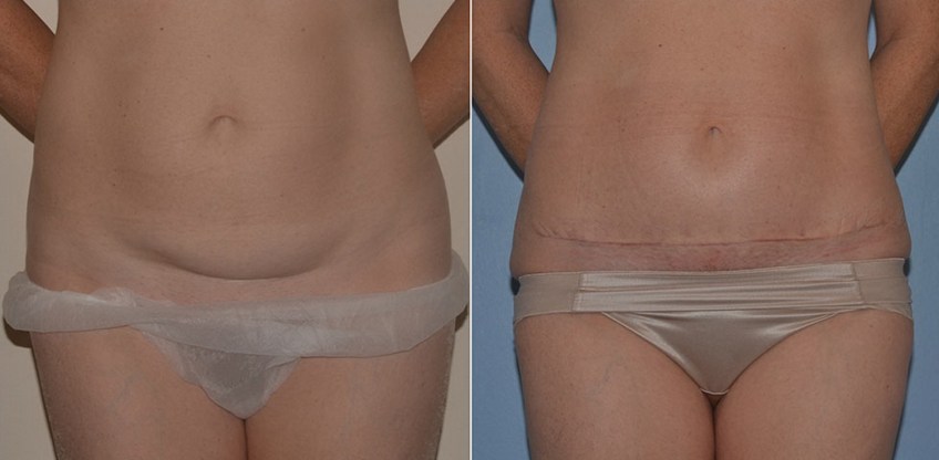 MEDICINA ONLINE MINIADDOMINOPLASTICA