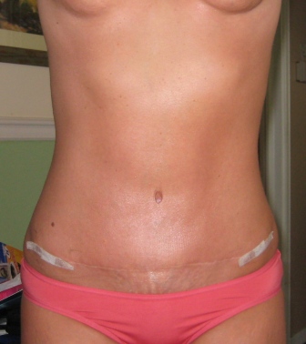 MEDICINA ONLINE ADDOMINOPLASTICA IMMAGINE