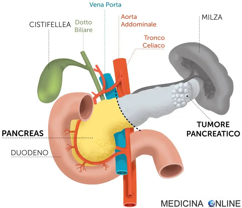 MEDICINA ONLINE pancresectomia distale complicanze dieta PANCREAS TESTA COLECISTI CISTIFELLEA STOMACO DUODENO INTESTINO CANCRO TUMORE MORTE SOPRAVVIVENZA ASPETTATIVA DI VITA