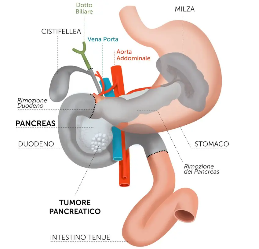 MEDICINA ONLINE pancresectomia TOTALE complicanze dieta PANCREAS TESTA COLECISTI CISTIFELLEA STOMACO DUODENO INTESTINO CANCRO TUMORE MORTE SOPRAVVIVENZA ASPETTATIVA DI VITA