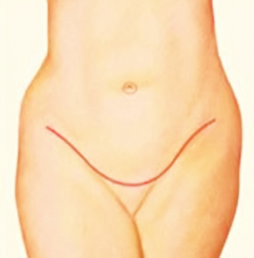 MEDICINA ONLINE ADDOMINOPLASTICA IMMAGINE