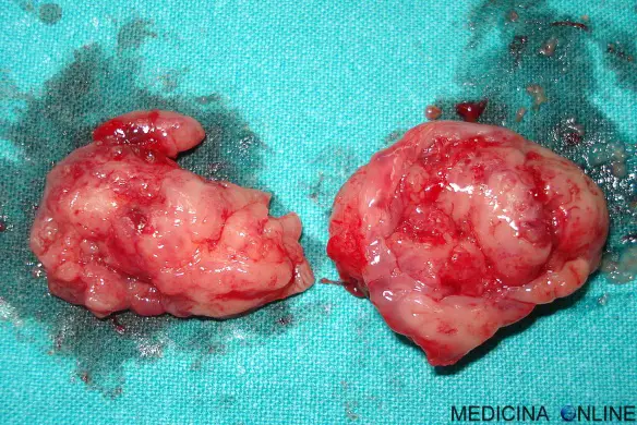 MEDICINA ONLINE TONSILLE DOPO ESSERE STATE RIMOSE gonfie, infiammate e con placche rimedi in adulti e bambini QUANDO OPERARE CHIRURGIA RIMOZIONE TONSILLE TONSILLECTOMIA TONSILLITE GOLA MALE NASO BOCCA DOLORE PLACCHE.jpg