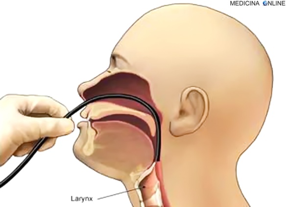 MEDICINA ONLINE LARINGOSCOPIA DIRETTA LARINGOSCOPIO FLESSIBILE FIBRE OTTICHE LARINGE FARINGE FUMO INALAZIONE RISCHIO MORTE DECESSO IPOSSIA CO OSSIGENO O2 ARIA PAURA PERICOLO RISCHI