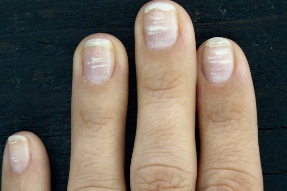 MEDICINA ONLINE LEUCONICHIA DISCROMIA COLORE UNGHIA MACCHIE BIANCHE RIMEDI CURE TERAPIE INTEGRATORI STRIATURE DA COSA SONO CAUSATE MANICURE PEDICURE BAMBINI ADULTI MANI PIEDI CALCIO MALNUTRIZIONE.jpg