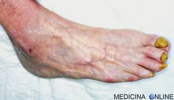 MEDICINA ONLINE ONICODISTROFIA UNGHIA PIEDE ONICOPATIA ONICOMICOSI ONICO