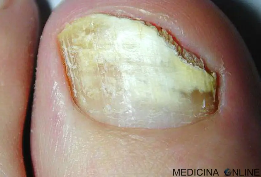 MEDICINA ONLINE ONICOMICOSI MICOSI UNGHIE IMMAGINE