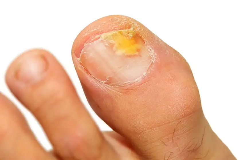 MEDICINA ONLINE ONICOMICOSI MICOSI UNGHIE IMMAGINE