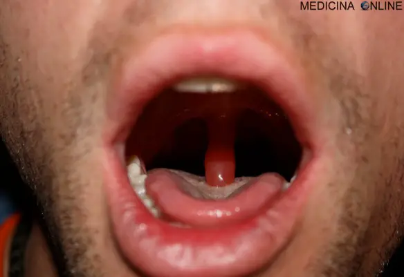 MEDICINA ONLINE UVULITE GONFIA UGOLA BOCCA LARINGE FARINGE DENTI LINGUA PARLARE CONSONATI UVULARI DOLORE INFIAMMATA INFETTA INFIAMMAZIONE INFEZIONE CAVO ORALE TONSILLE PLACCHE CANTARE VOCE CORDE VOCALI IMMAGINI BIFIDA.jpg