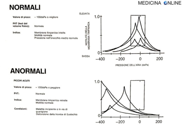 MEDICINA ONLINE ESAME IMPEDENZOMETRICO TIMPANOGRAMMA RIFLESSI ENDOTIMPANICI STAPEDIALI PROCEDURA VALORI NORMALI PATOLOGICI DECIBEL SORDITA IPOACUSIA OTORINOLARINGOIATRA COSTO ORECCHIO BAMBINI DISABILI COLLABORANTE TIMPANO.jpg