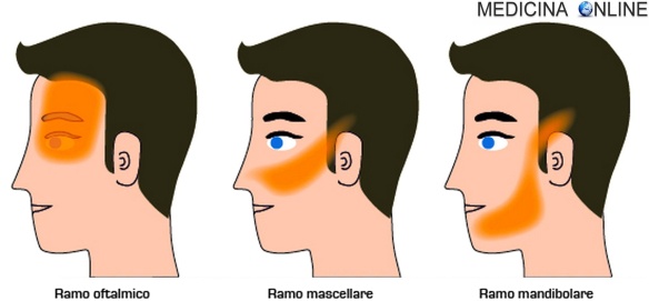 MEDICINA ONLINE NEVRALGIA DEL NERVO TRIGEMINO 5 V NERVO INTRACRANICO ENCEFALICO DOLORE LANCINANTE FREDDO IMPACCO DIETA COSA MANGIARE FACCIA TEMPIA OCCHI MANDIBOLA VISO TESTA CURE NATURALI CHIRURGIA