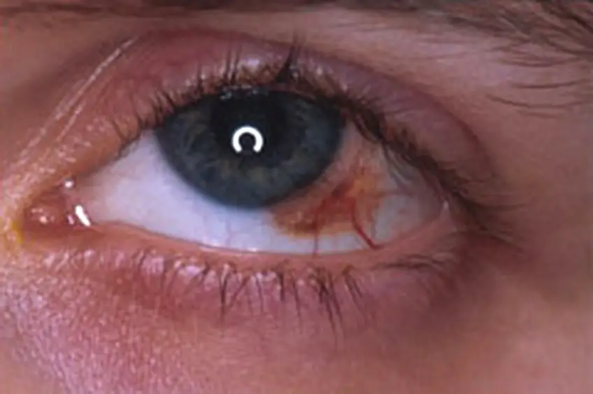 MEDICINA ONLINE TUMORE CANCRO OCCHIO IMMAGINE