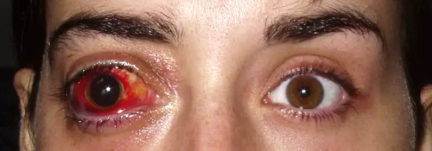 MEDICINA ONLINE TUMORE CANCRO OCCHIO IMMAGINE