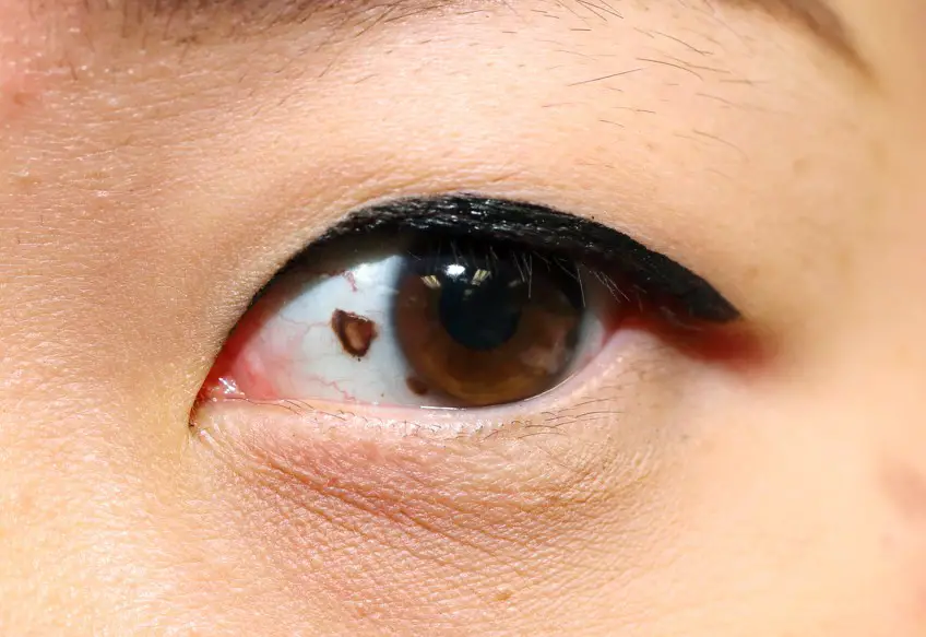 MEDICINA ONLINE TUMORE CANCRO OCCHIO IMMAGINE