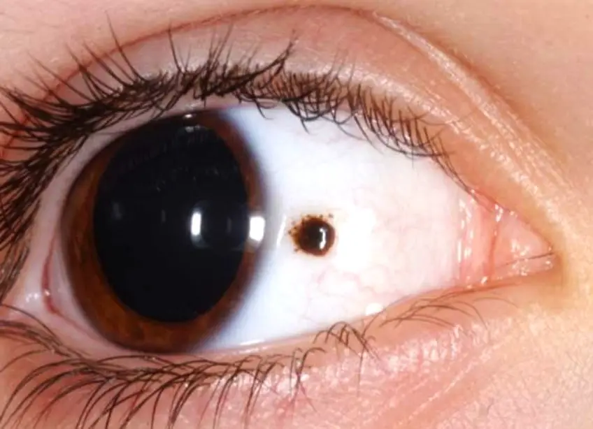 MEDICINA ONLINE TUMORE CANCRO OCCHIO IMMAGINE