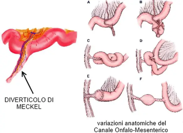 MEDICINA ONLINE CAMPIONE CHIRURGICO DIVERTICOLO DI MECKEL INTESTINO CHIRURGIA TENUE ILEO POSIZIONE DOVE SI TROVA CHIRURGIA 3.jpg